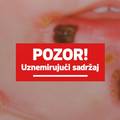 &Scaron;to je impetigo? Zarazna infekcija ko&zcaron;e &scaron;iri se Jadranom, a naj&ccaron;e&scaron;&cacute;e poga&dstrok;a djecu