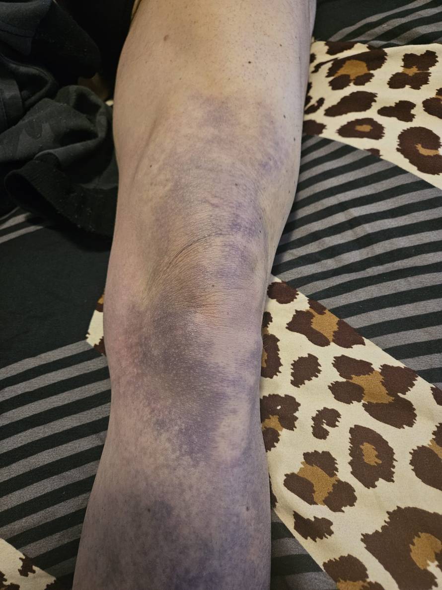 Super Silva za 24sata: Znam tko me napao, bilo je iznenada i s leđa. Jedna noga mi je uništena