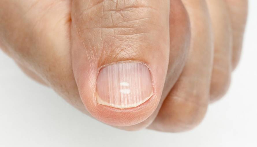 Kada doktoru: Imate vodoravne ili okomite nabore na noktima?