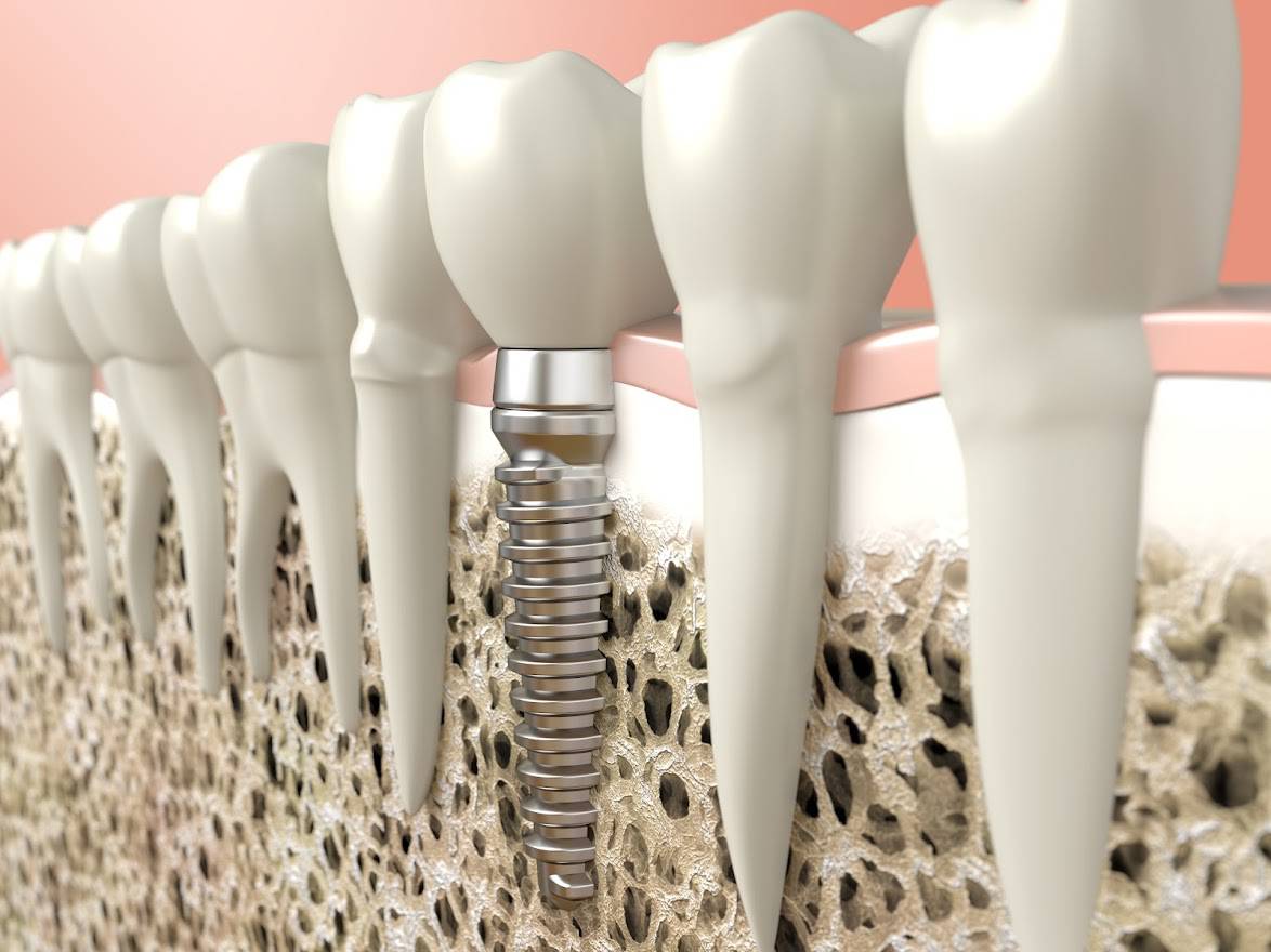 Nedostaje vam zub?! Otkrijte zašto je zubni implantat najbolje rješenje