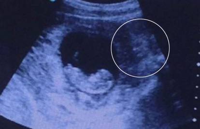 Demon: Na ultrazvuku dijete 'čuva' zastrašujuća prikaza?!