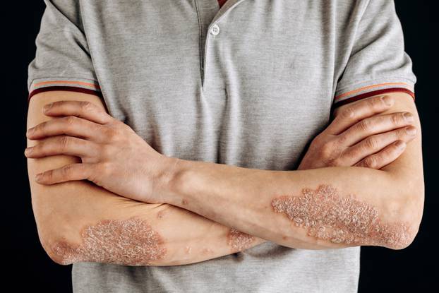 Acute,Psoriasis,On,The,Elbows,Is,An,Autoimmune,Incurable,Dermatological