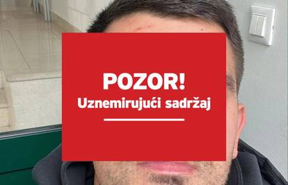 VIDEO Kaos u Orebiću: Šef kluba ugrizao suparnika za oko! Evo kako izgledaju napadnuti igrači