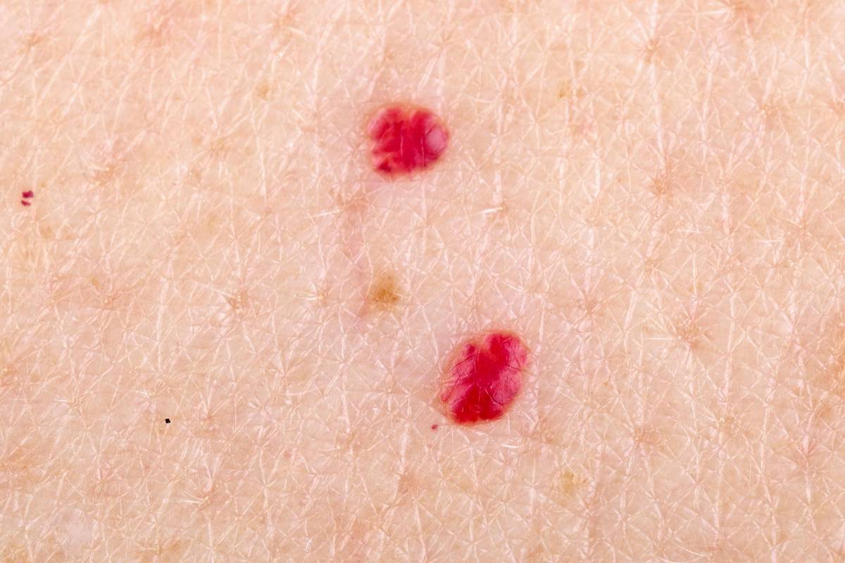 Na koži su vam se pojavile ove crvene točkice? Evo što je to...