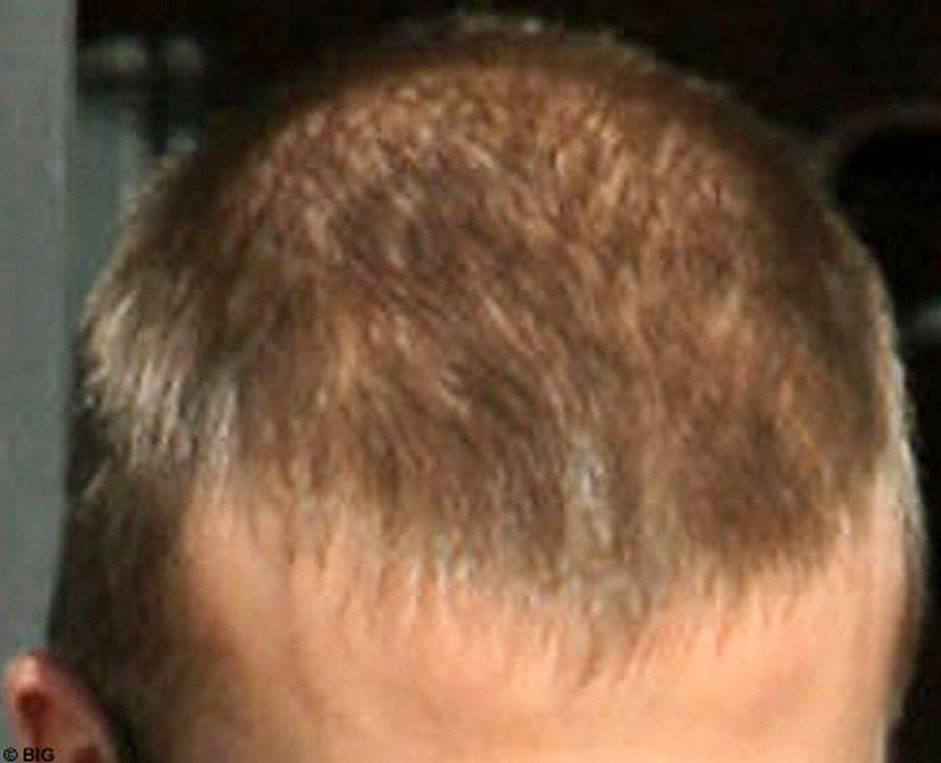 Волосы форум мужчины. David Beckham лысеет. Дэвид Бекхэм полысел. Дэвид Бекхэм облысение волосы. Дэвид Бекхэм пересадка волос.
