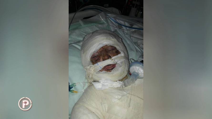 Izgorjelo mu 70% tijela: Meho je nakon operacija opet u školi