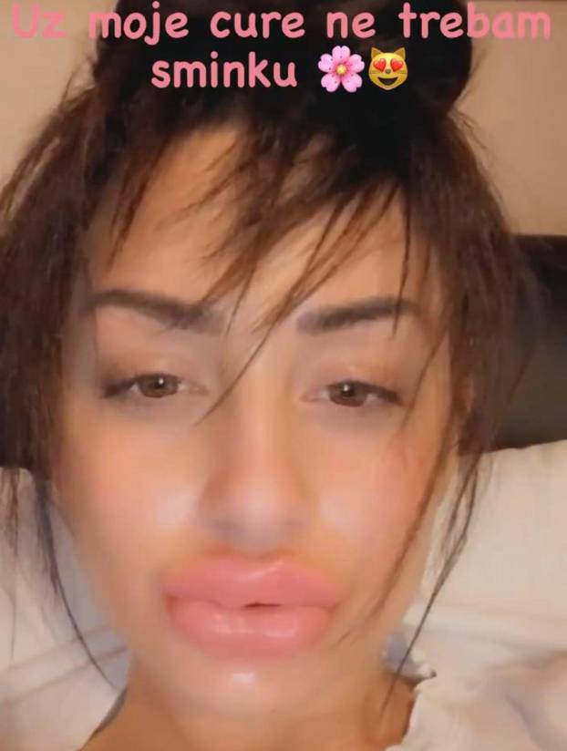 Na kirurga koji je unakazio žene žalila se i Kristina Mandarina. Evo što je njoj operirao...