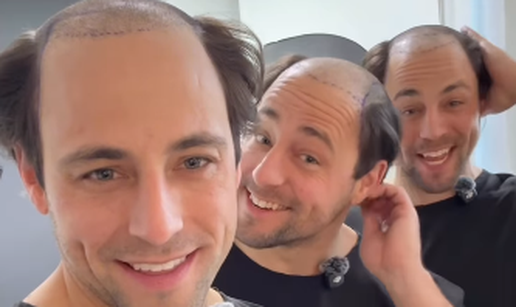 Troj&ccaron;eki otputovali u Tursku na transplantaciju kose: 'Ne mo&zcaron;e samo jedan imati dobru frizuru'