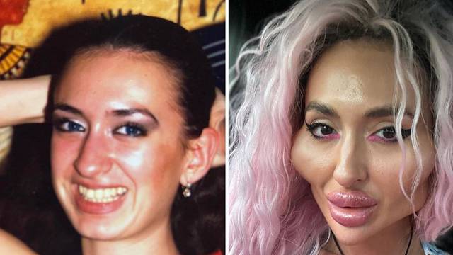 Prije i poslije: Žena s najvećim jagodicama na svijetu pokazala svoju drastičnu transformaciju