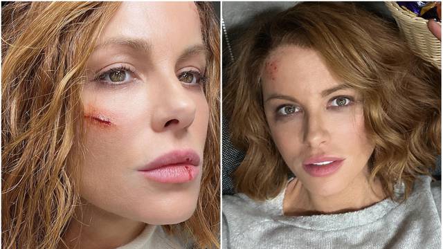 Vizažistica Tatjana o povredama Kate Beckinsale: 'Ozljede nisu stvarne, ja sam ju našminkala'