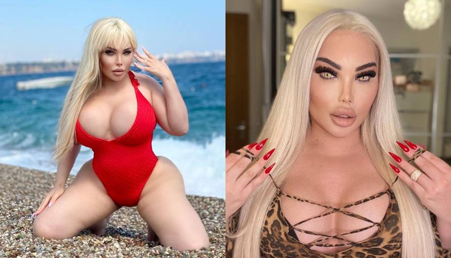 Bivši 'ljudski Ken'  ostavio samo 20%  želuca nakon operacije: 'Više uopće ne osjećam glad ...'