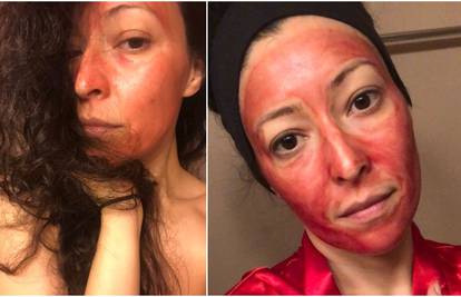 Bizaran beauty tretman: Na lice stavlja svoju krv da bude ljepša