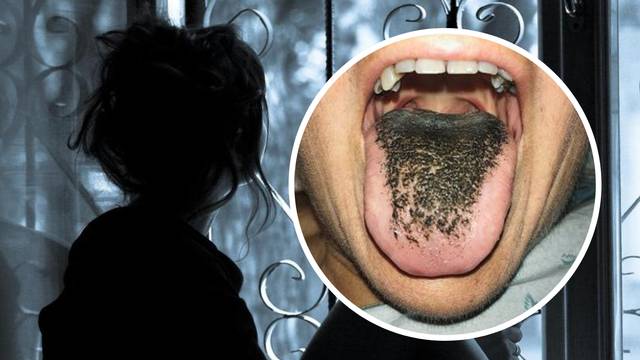 Šokirala se: Zbog antibiotika joj rastu crne 'dlake' na jeziku