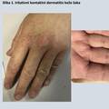 Dezinficijensi i rukavice iritiraju kožu: Evo kako možete umanjiti oštećenja na svojim rukama