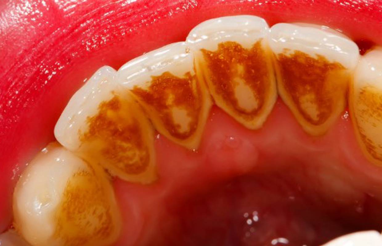 Muči li vas zubni kamenac koji se stalno stvara? Evo kako ga se riješiti kod kuće