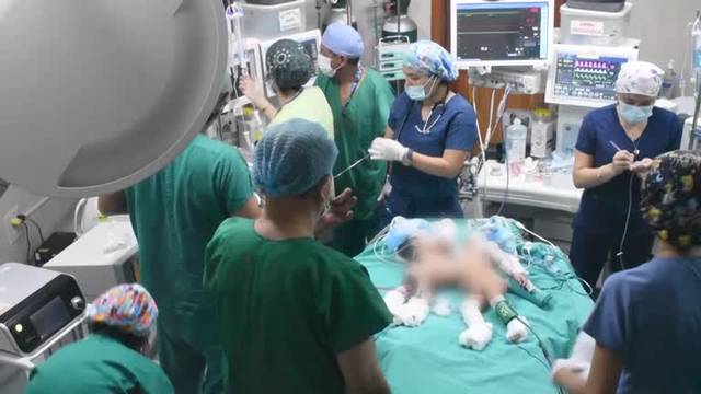 Conjoined babies successfully separated in Peru
