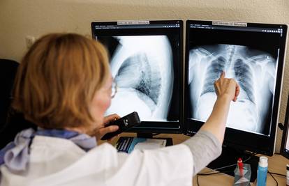 WHO: Rak pluća je opet najčešći rak. To je povezano s upornom upotrebom duhana u Aziji