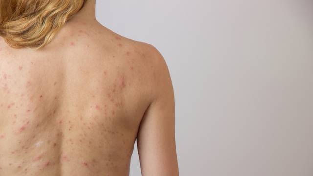 Young girl with acne, with red spots on the back