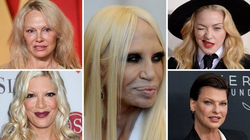 FOTO Bolno za gledati! Htjeli su se malo 'popeglati', ali botoks i operacije su im uništili izgled...