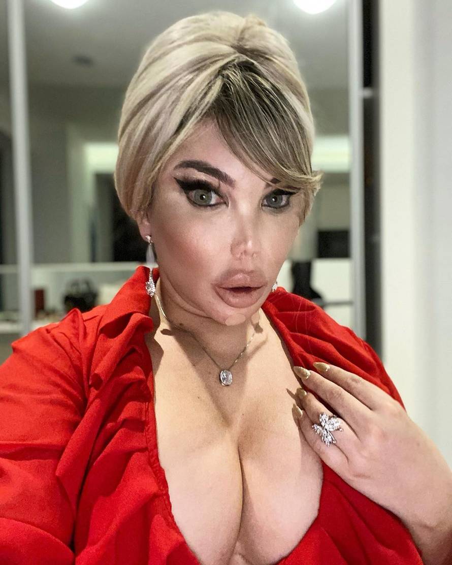 Bivši 'ljudski Ken' objavio fotku bez filtera: 'Što je s liječnicima koji te i dalje pristaju operirati?'