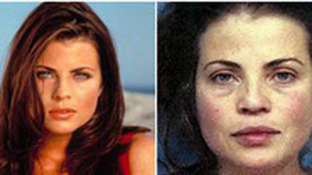 Prije i poslije: Ovim zvijezdama su teške ovisnosti uništile lica