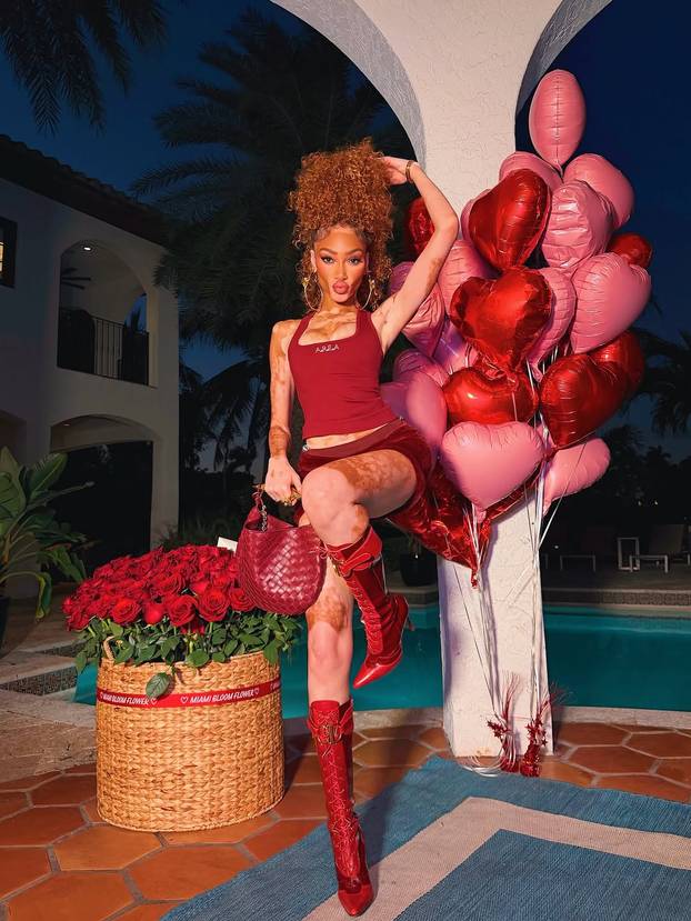 FOTO Rugali su joj se zbog bolesti, a danas je obožavaju zbog jedinstvenog izgleda