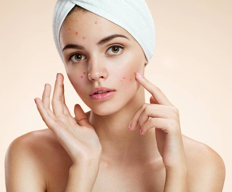 Mitovi ili ne? Akne će nestati od bjelanjka, paste za zube...