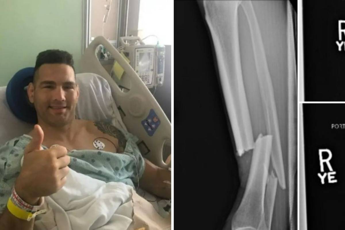 Uh, strašno: Weidman objavio rendgenske snimke loma noge