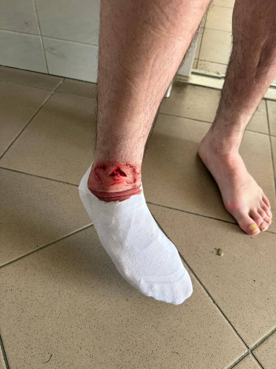 FOTO Pogledajte kako izgleda noga bivšeg hajdukovca nakon utakmice Prve NL u Sesvetama