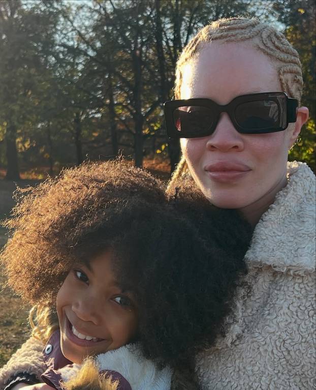 FOTO Afrikanka s albinizmom osvaja modnu industriju: 'Često privlačim znatiželjne poglede'