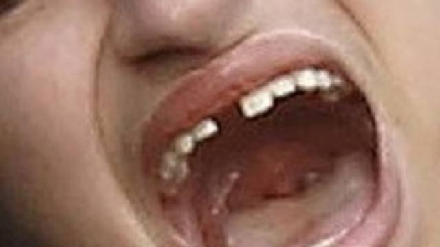 I dan danas misterij: Zubi koji eksplodiraju uz glasan prasak