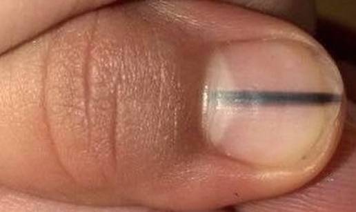 Pojavila vam se crna crta ispod nokta? Odmah oti&dstrok;ite lije&ccaron;niku