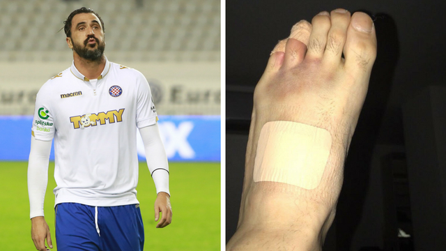 Šok za Hajduk: Almeidi pukla kost u stopalu protiv Rudeša!