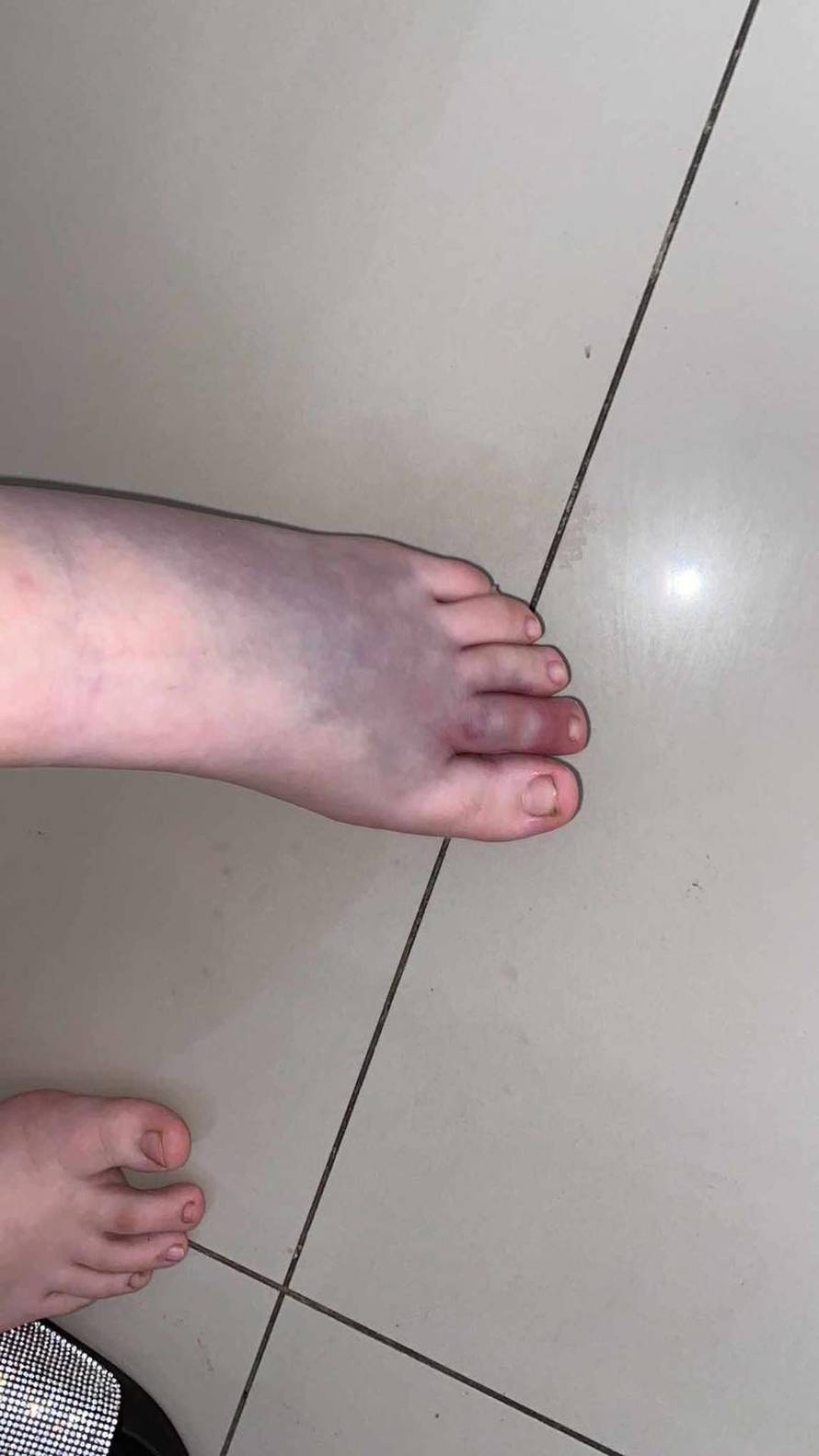 Poskok ugrizao djevojčicu u BiH,  objavili fotografije kako bi upozorili ostale mještane