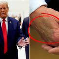 Doktor za 24sata o Trumpovoj modrici na ruci: Nema šanse da je to od rukovanja. Evo što je