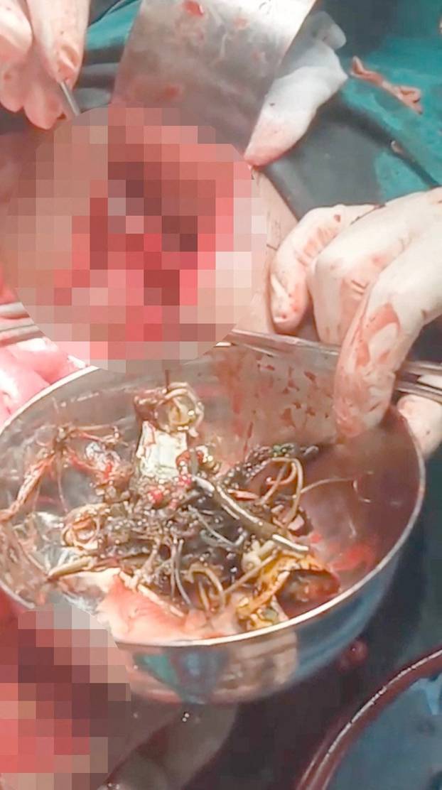 EXCLUSIVE: Man who had tummy ache for TWO YEARS had eaten over 60 items including earphones, screws and buttons
