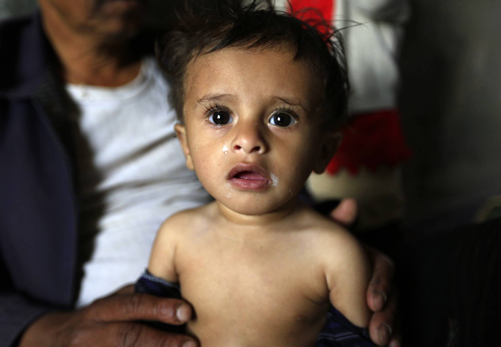 Najveća kriza: U Jemenu 360 tisuća životno ugrožene djece
