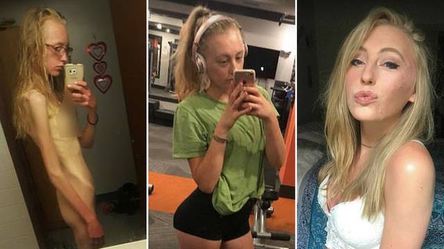 Zbog anoreksije pala na 41 kg: Nije pila vodu da se ne udeblja
