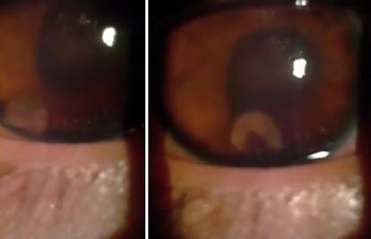 Žalio se na bolove, gubio vid... : Muškarcu u oku pronašli crva