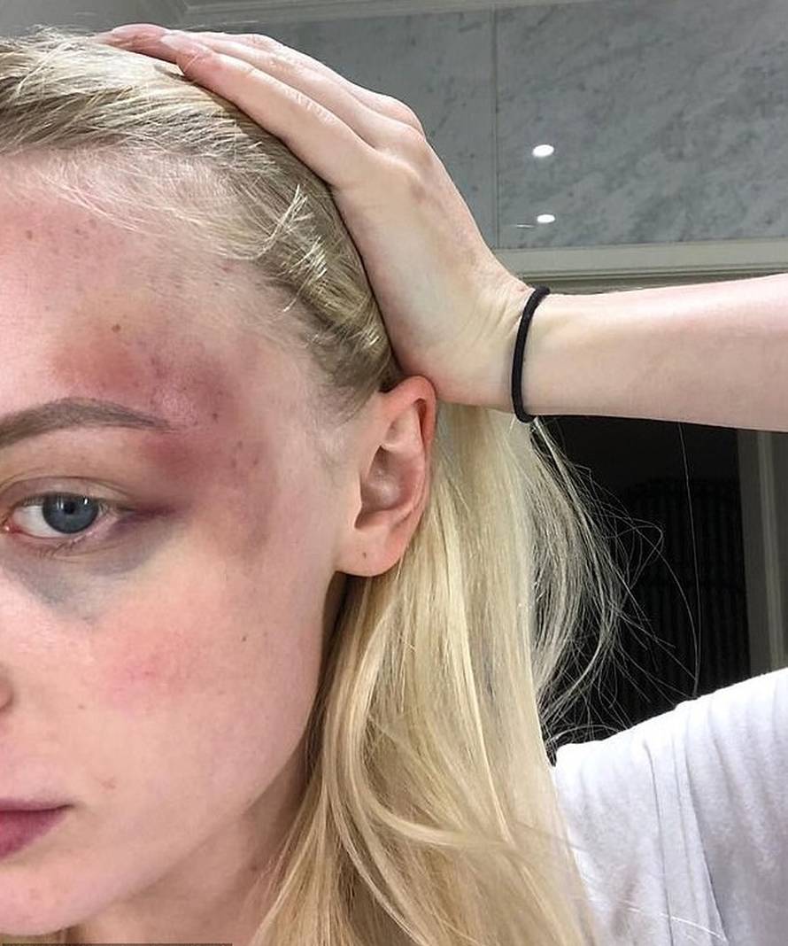 Manekenka je objavila modrice koje joj je nanio dečko: 'Tuga i bol, izlazim jača iz ove veze...'