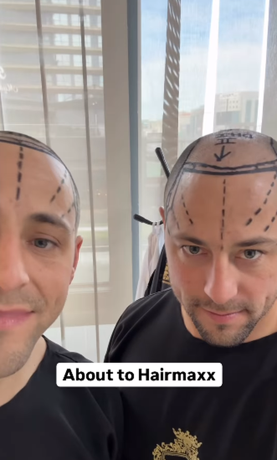 Trojčeki otputovali u Tursku na transplantaciju kose: 'Ne može samo jedan imati dobru frizuru'