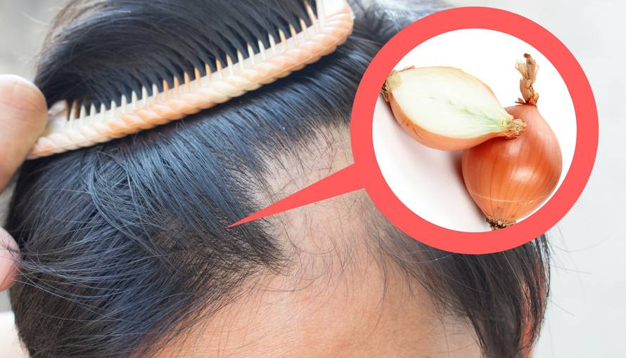 Trik s lukom za zaustavljanje gubitka kose i njezin brži rast