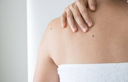 Čuvajte se Sunca: Evo što sve treba znati o najsmrtonosnijem raku kože - melanomu