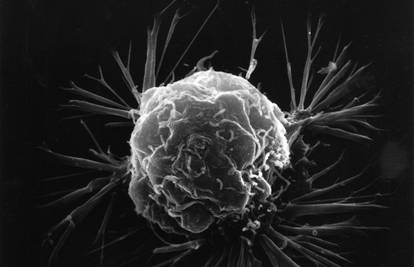 Revolucija u liječenju raka: Stanice tumora lovit će virusi