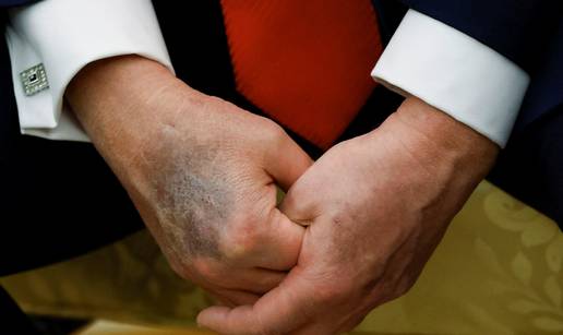 FOTO Tvrdi da je zdrav ko dren: Pogledajte Trumpovu ruku i masnice iz mjeseca u mjesec