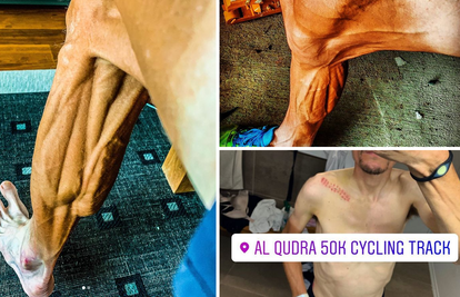Šokantno: Kako izgledaju noge biciklista koji boluje od bulimije