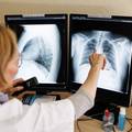 WHO: Rak pluća je opet najčešći rak. To je povezano s upornom upotrebom duhana u Aziji