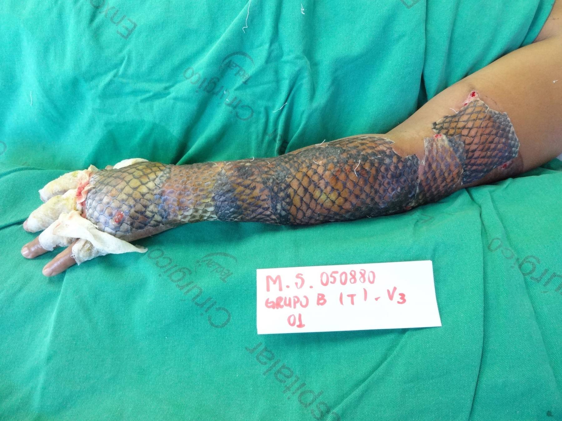 Burns survivor uses fish skin