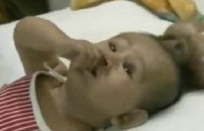 Indijski liječnici spasili dječaka koji se rodio s 'bratom' na glavi