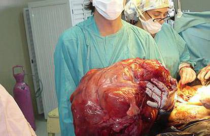Izvadili tumor od 23 kg iz žene, vjeruju da je najveći